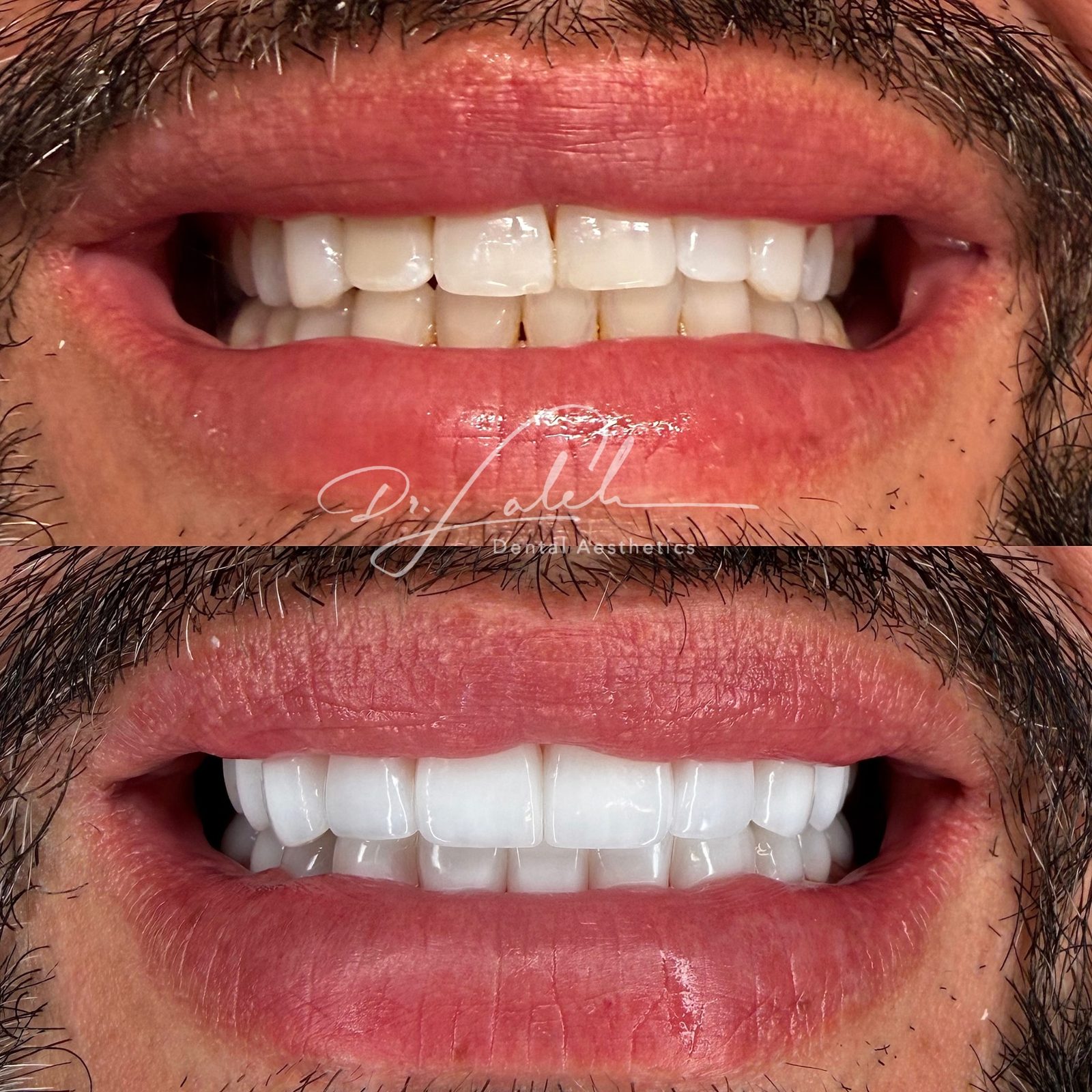 Smile transformation case 001 — before and after by Dr. Laleh Mehrrafiee, DDS