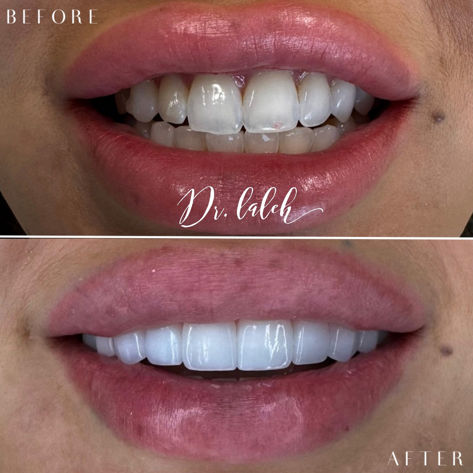 Smile transformation case 002 — before and after by Dr. Laleh Mehrrafiee, DDS