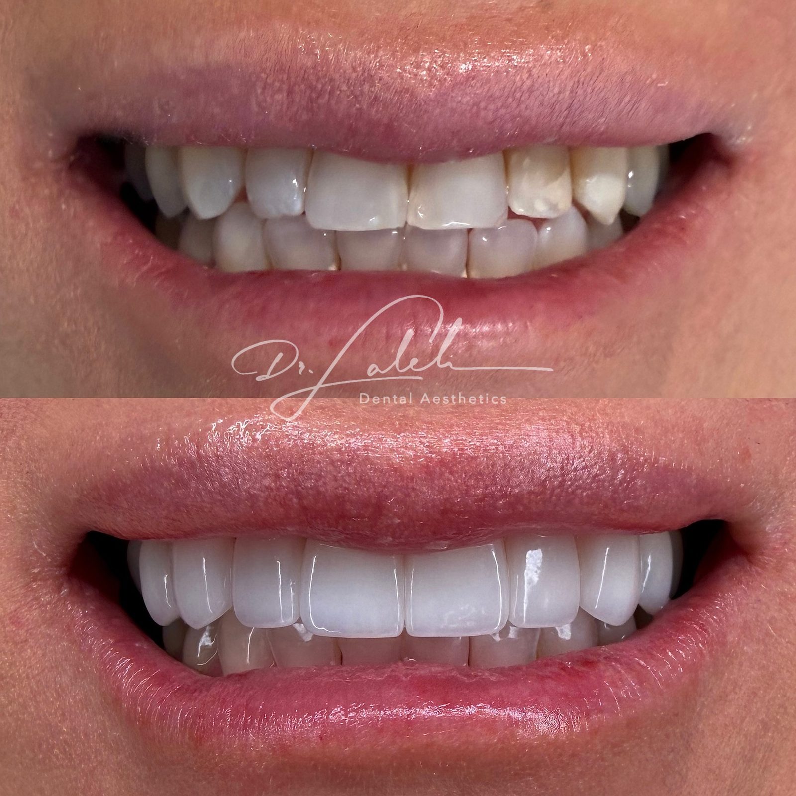 Smile transformation case 004 — before and after by Dr. Laleh Mehrrafiee, DDS