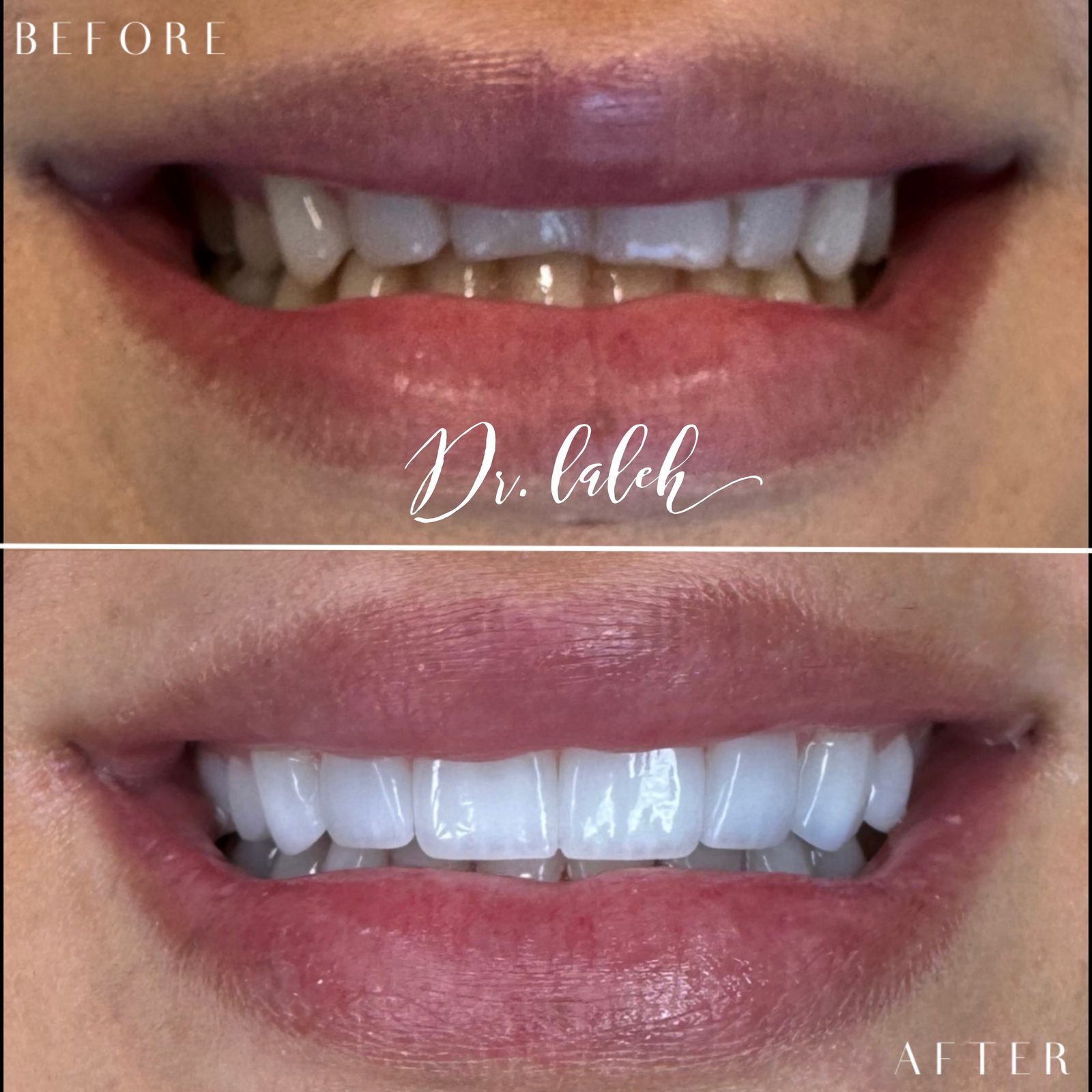 Smile transformation case 006 — before and after by Dr. Laleh Mehrrafiee, DDS
