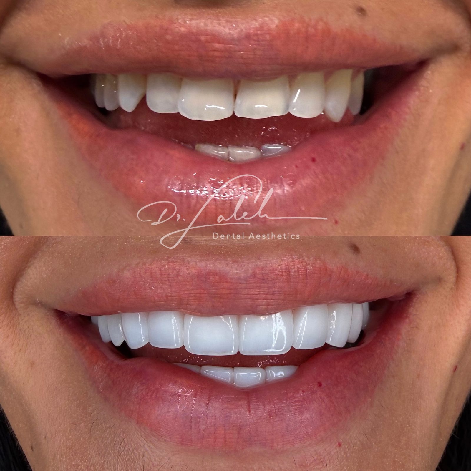 Smile transformation case 008 — before and after by Dr. Laleh Mehrrafiee, DDS