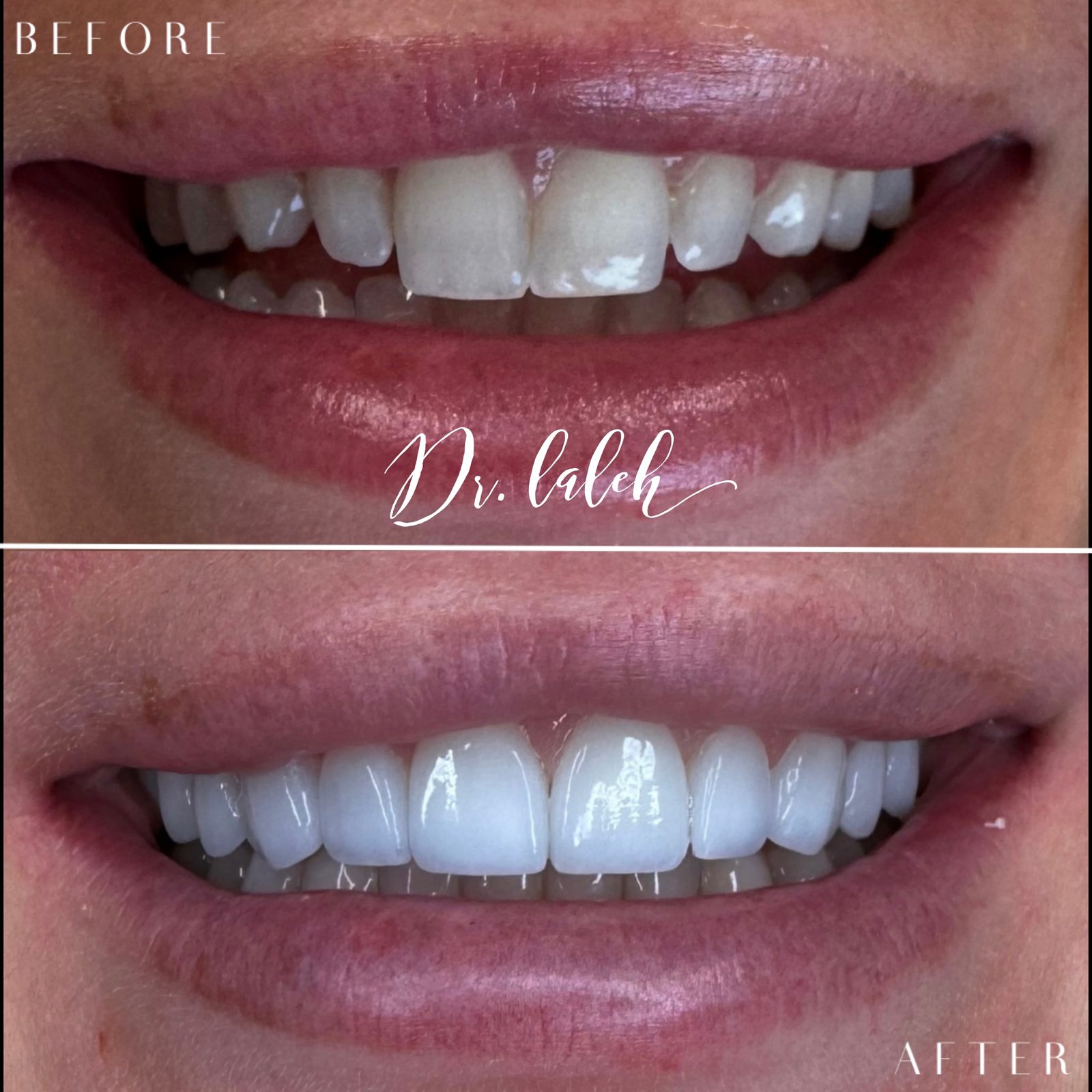 Smile transformation case 009 — before and after by Dr. Laleh Mehrrafiee, DDS