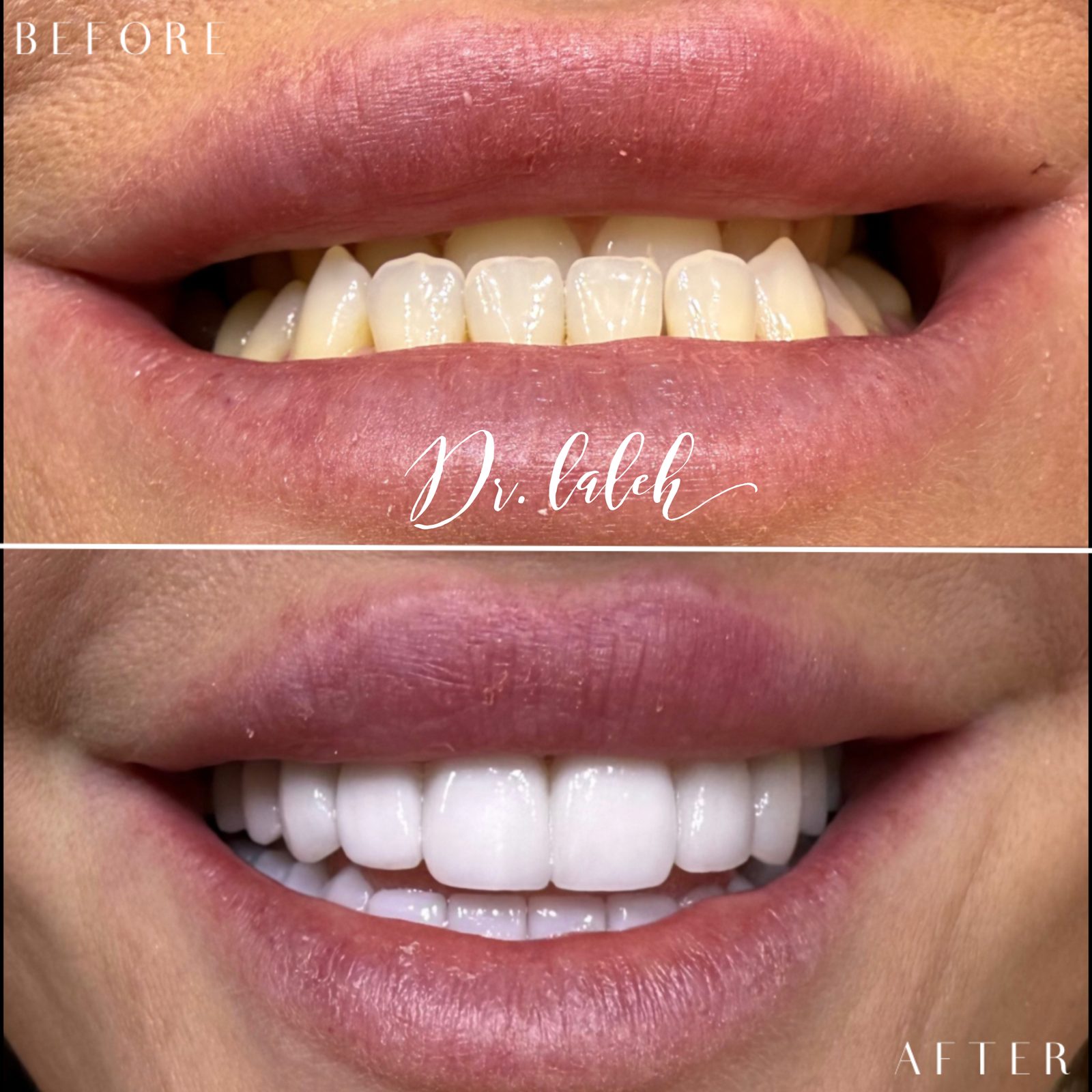 Smile transformation case 011 — before and after by Dr. Laleh Mehrrafiee, DDS