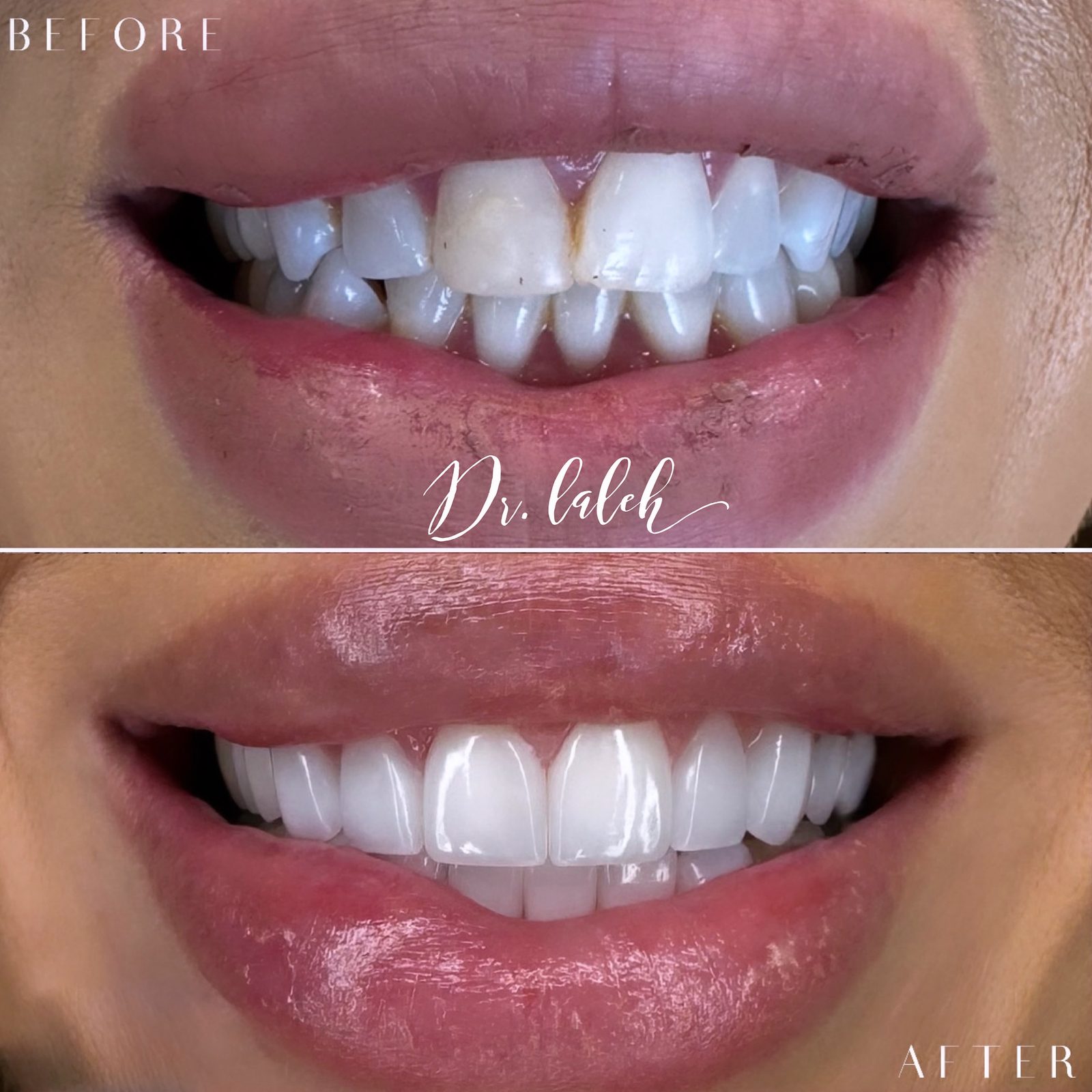 Smile transformation case 012 — before and after by Dr. Laleh Mehrrafiee, DDS
