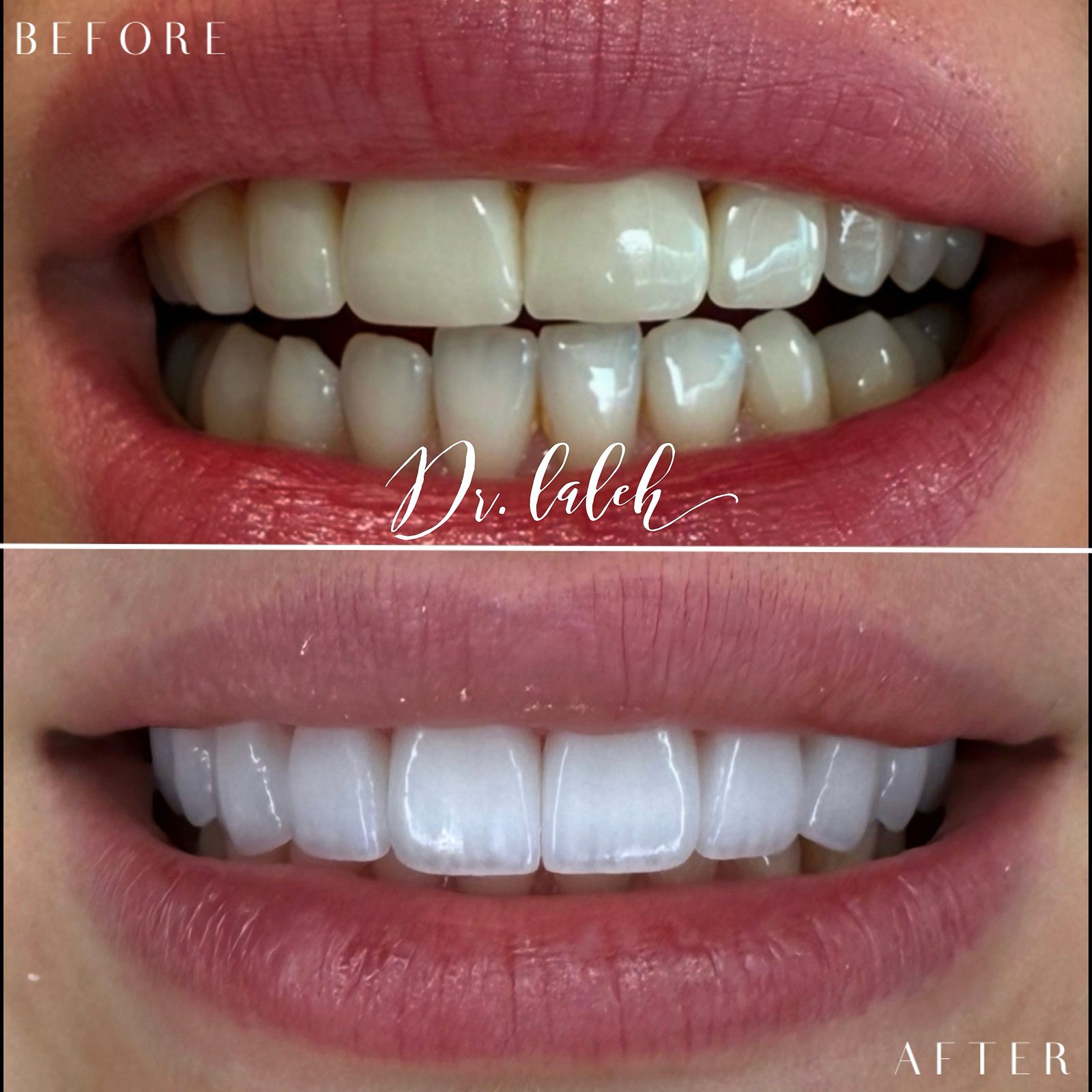 Smile transformation case 013 — before and after by Dr. Laleh Mehrrafiee, DDS