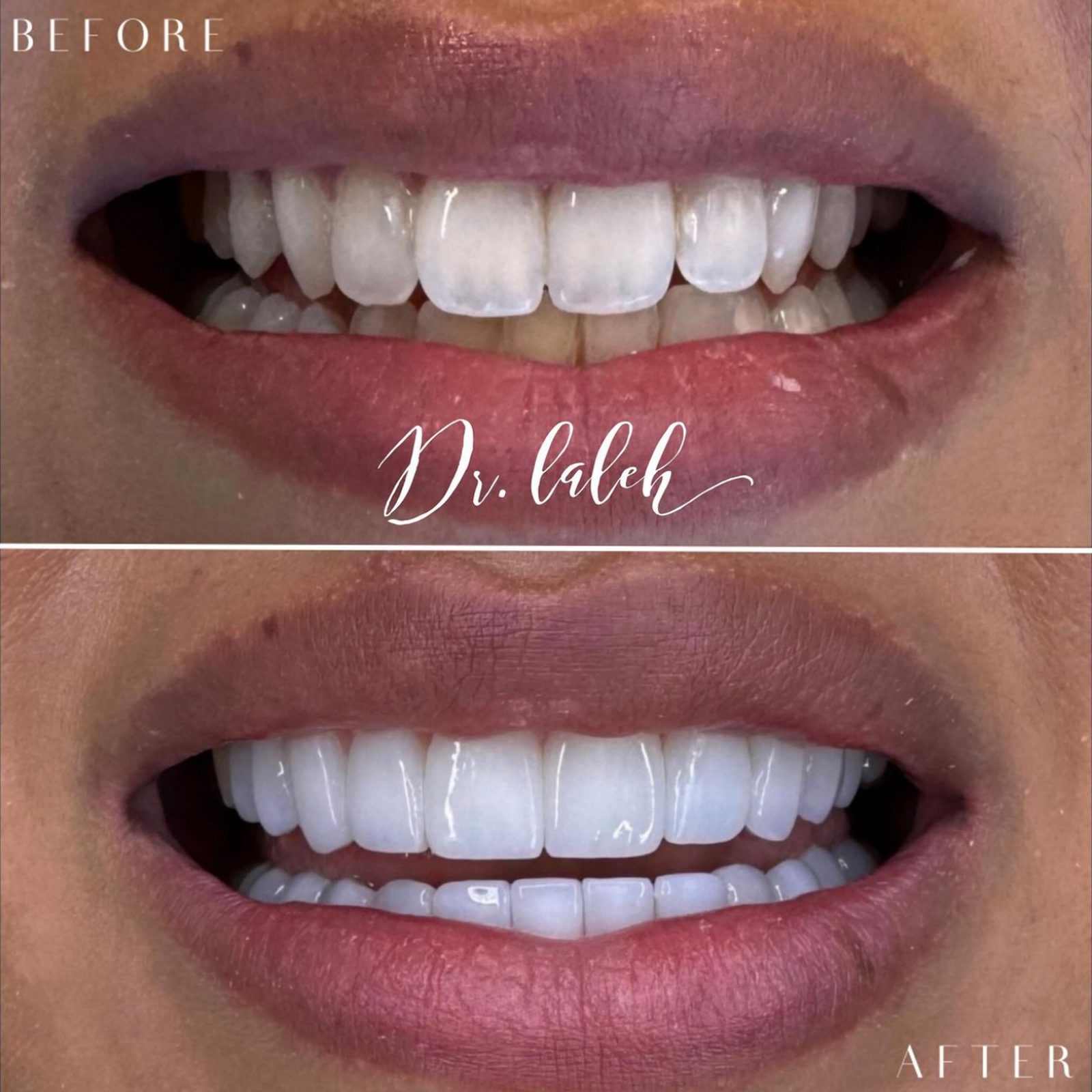Smile transformation case 020 — before and after by Dr. Laleh Mehrrafiee, DDS