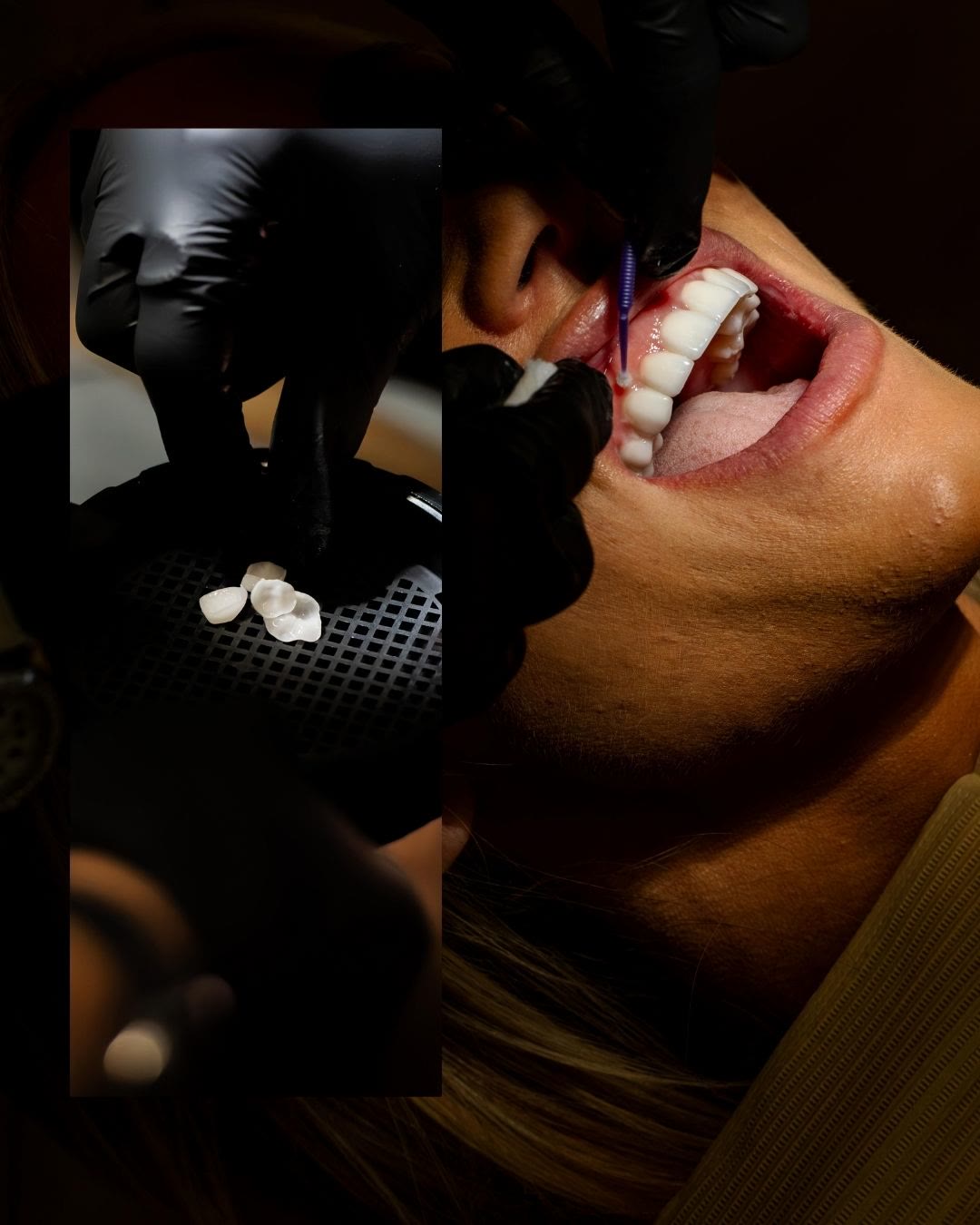 Handcrafted ultra-thin porcelain veneers being bonded to the teeth with a conservative, precise technique
