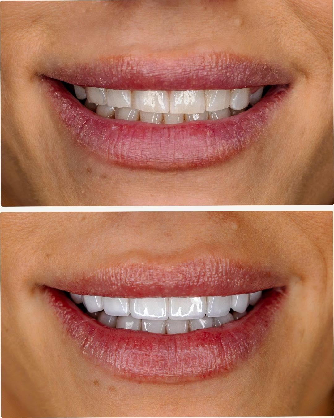 Before-and-after of no-prep porcelain veneers by Dr. Laleh: a brighter, more even, natural-looking smile