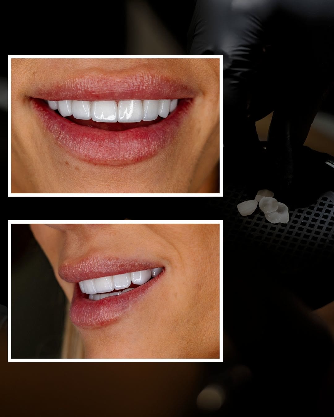 Custom smile design showing finished porcelain veneers crafted for natural shape, symmetry and shade